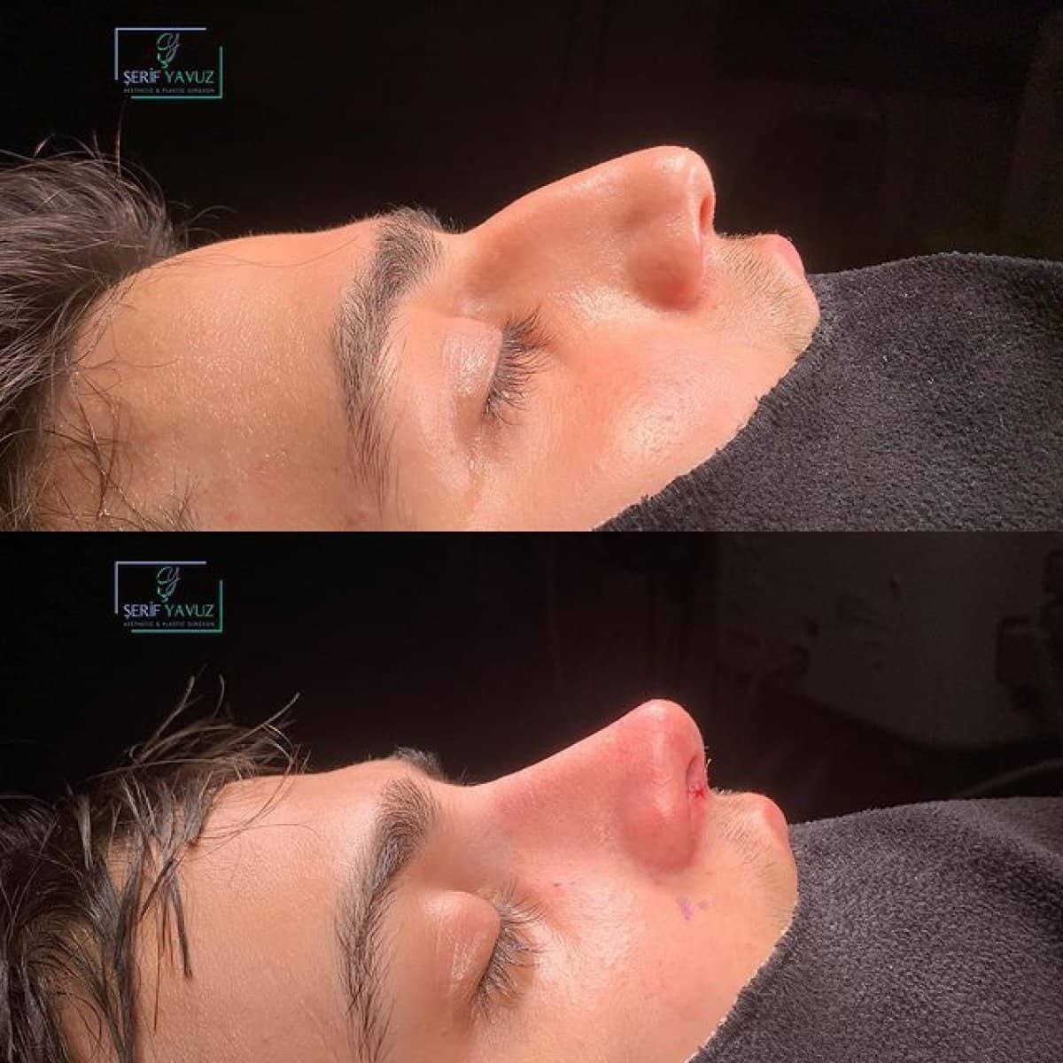 Case 20011 - rhinoplasty