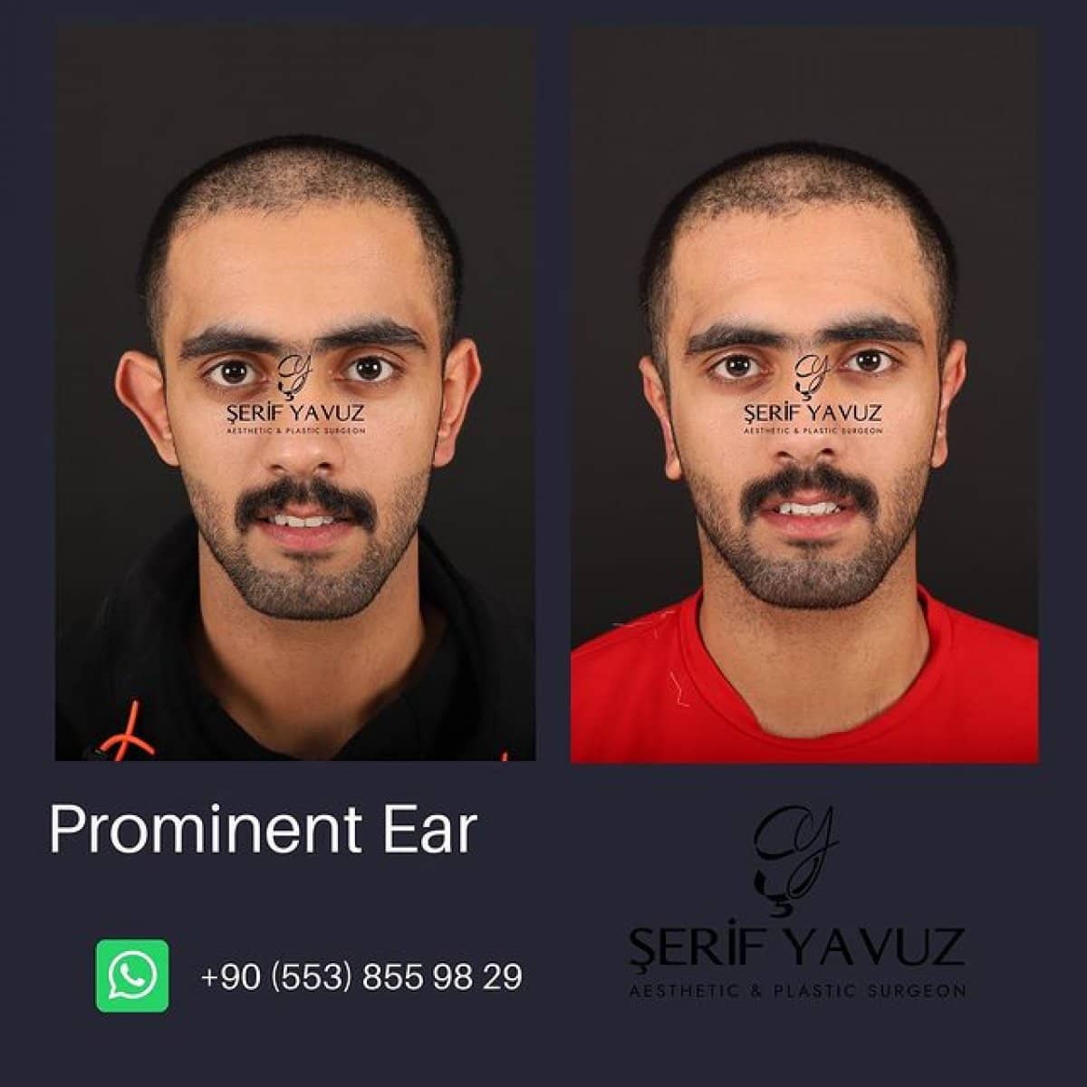 Case 20012 - otoplasty