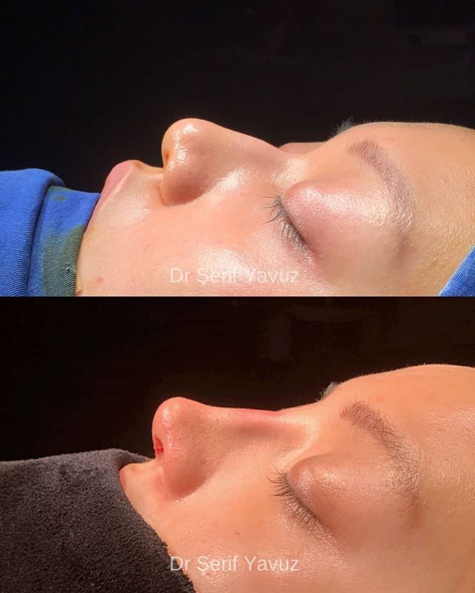 Case 20014 - rhinoplasty