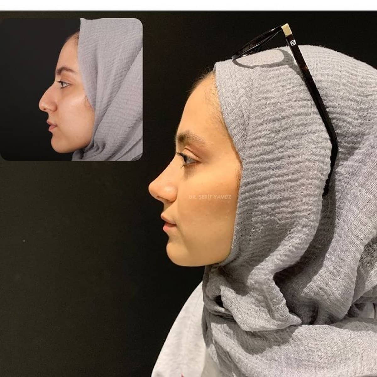 Case 20015 - rhinoplasty