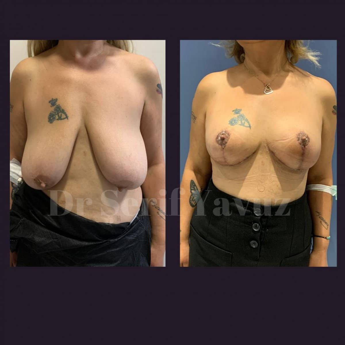 Case 20016 - breast lift