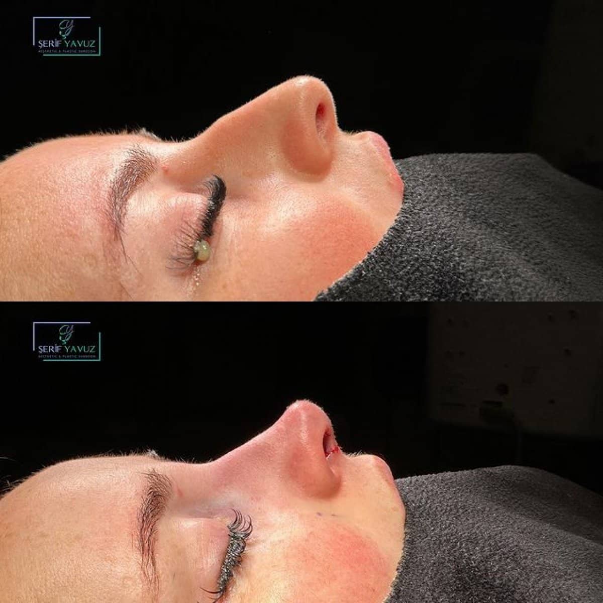 Case 20017 - rhinoplasty