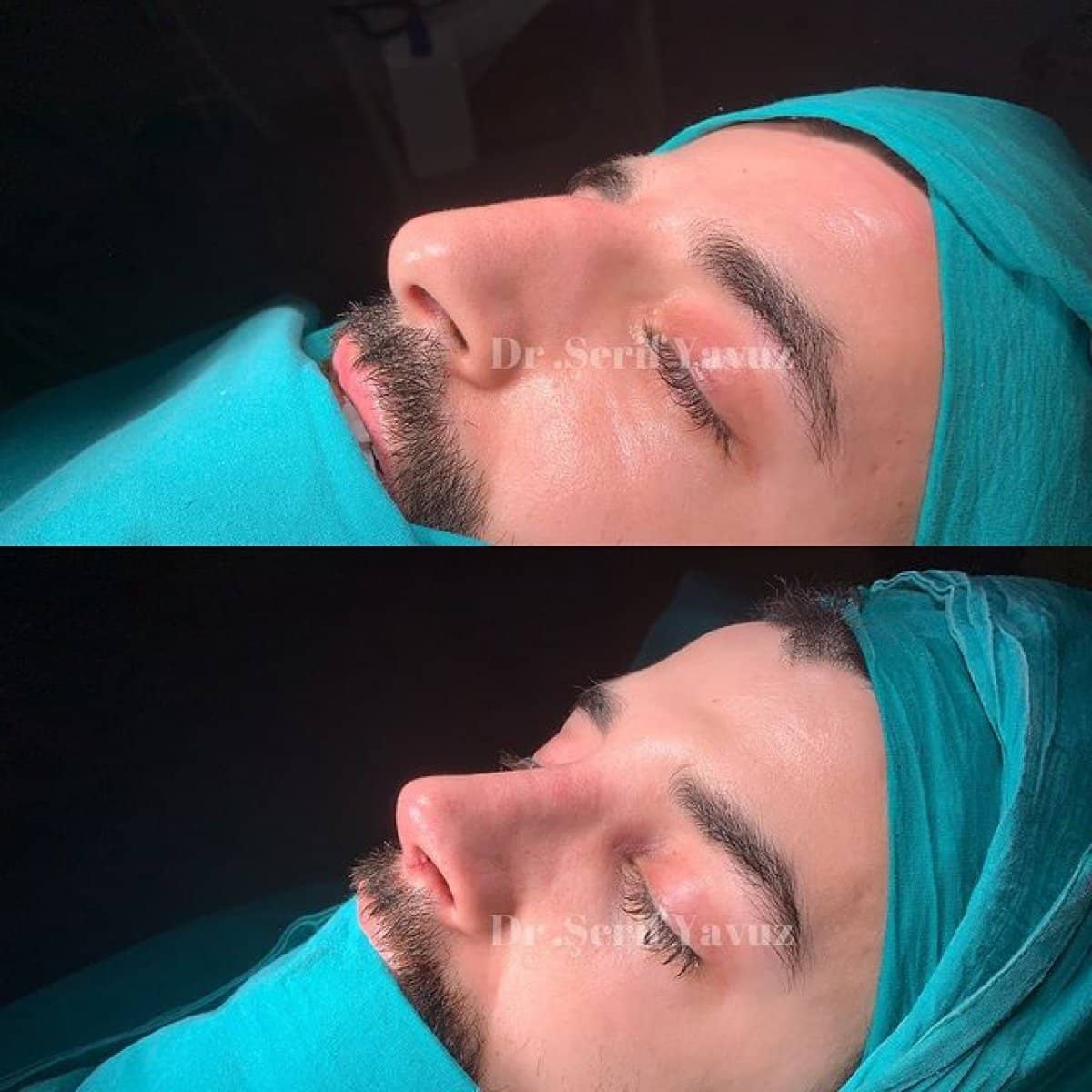 Case 20018 - rhinoplasty