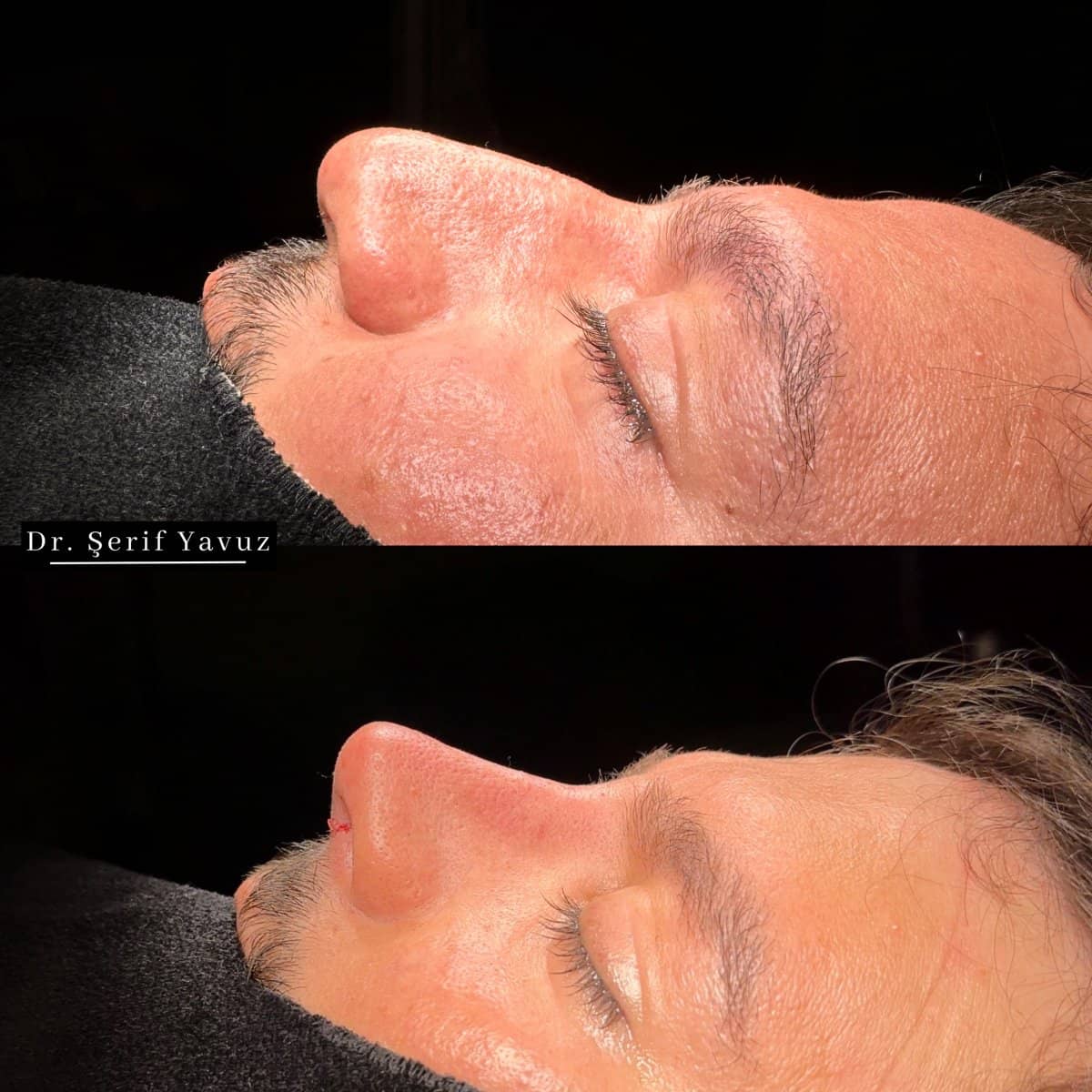 Case 20022 - rhinoplasty