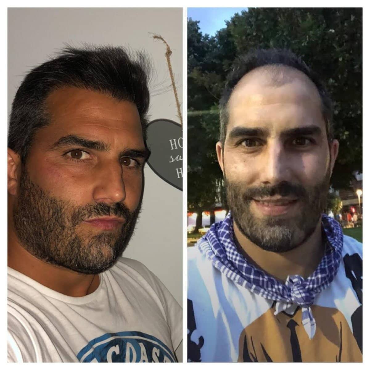 Case 20030 - hair transplant