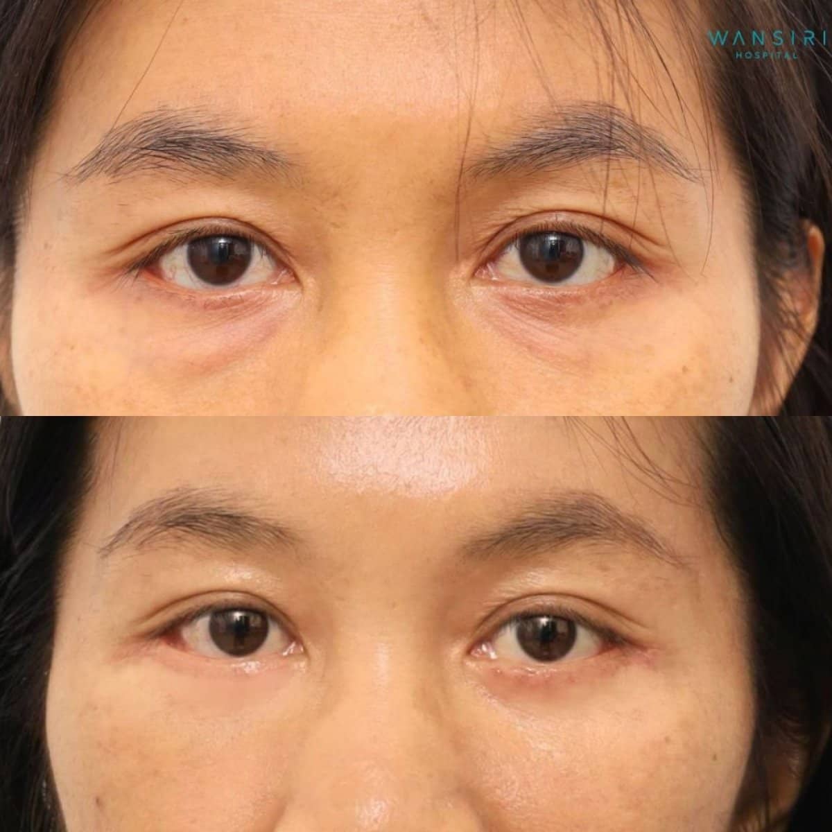 Case 20045 - lower eyelid blepharoplasty