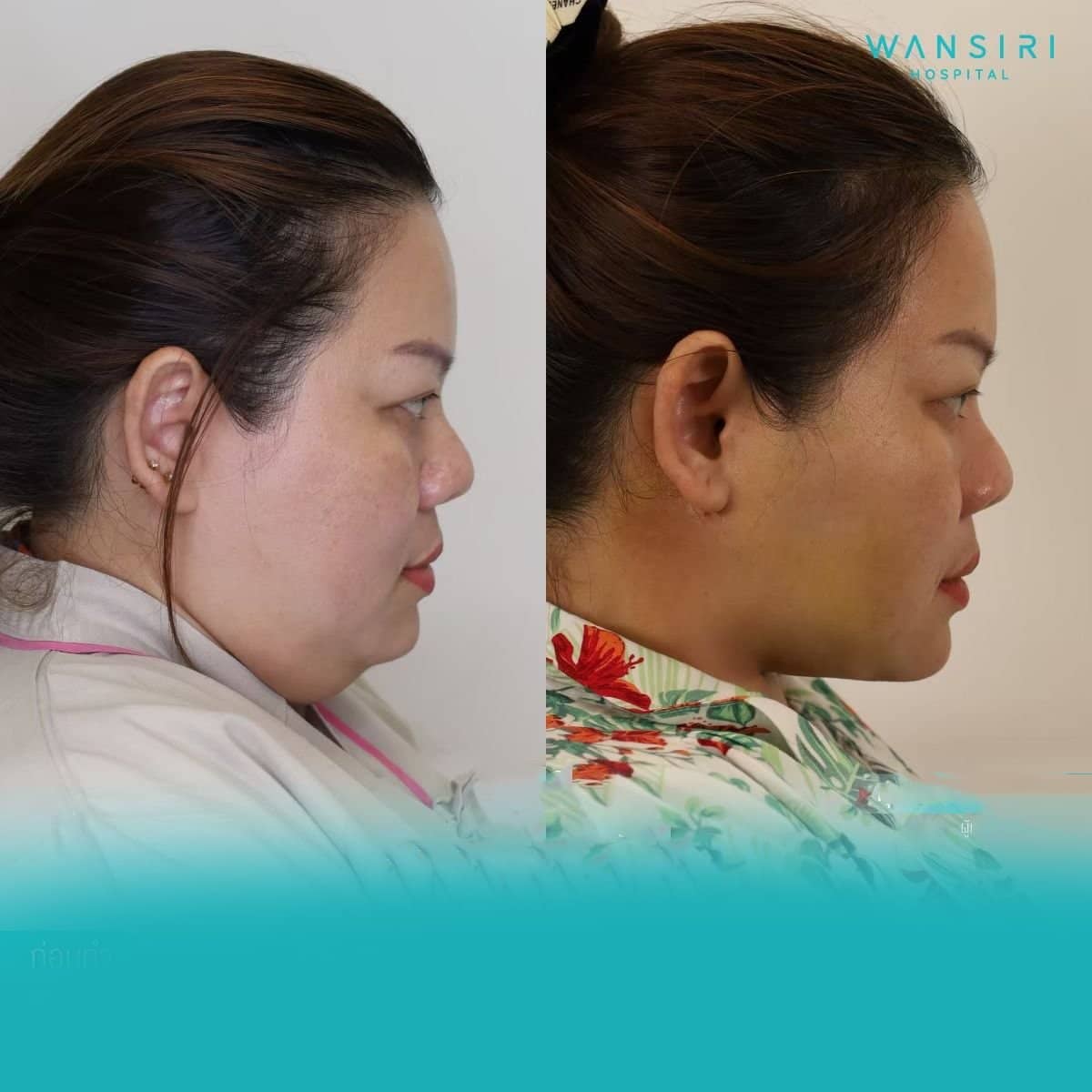 Case 20047 - Vaser liposuction
