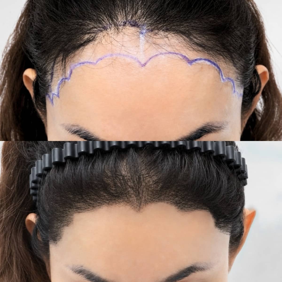 Case 20048 - FUE hair transplant