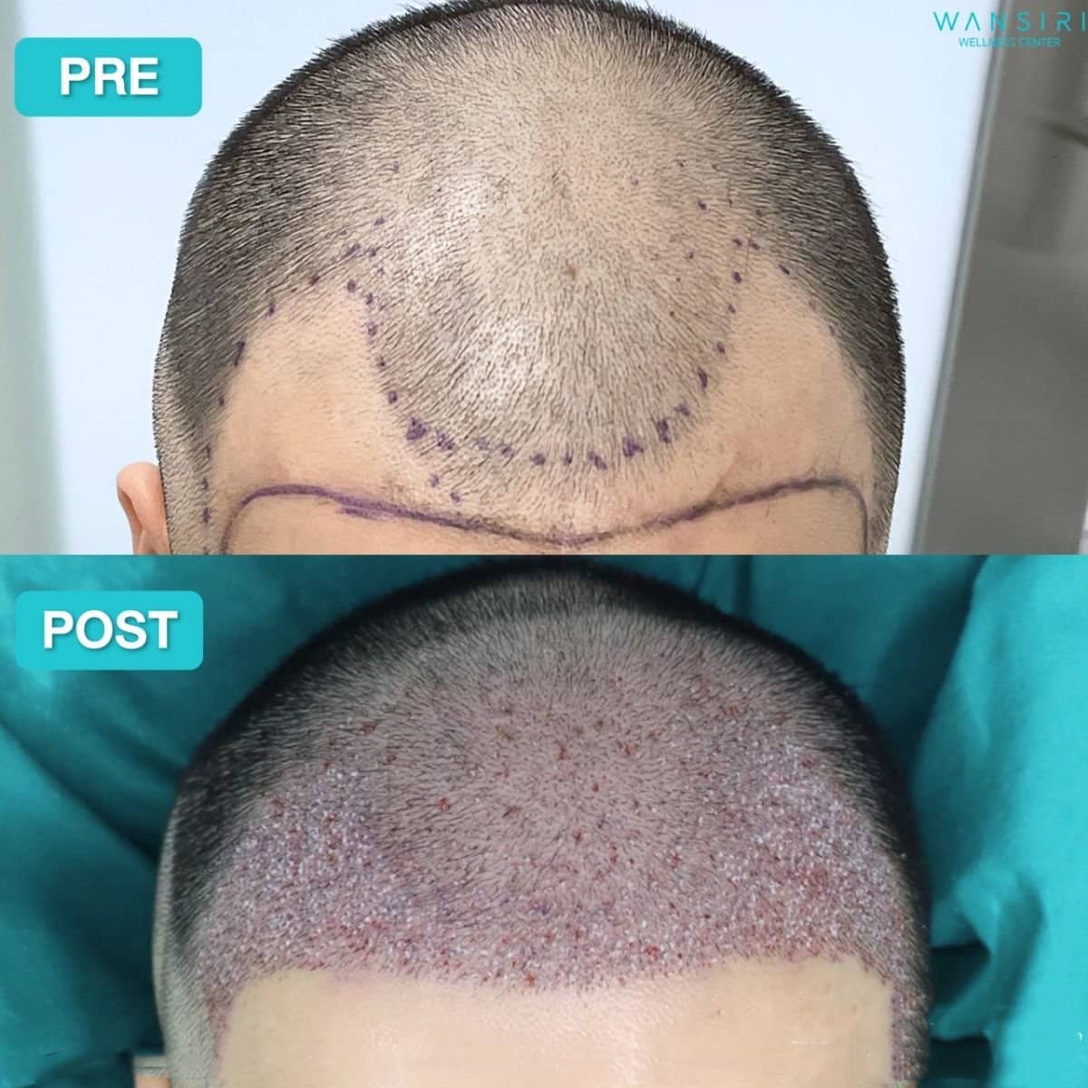 Case 20049 - PRP hair loss treatment