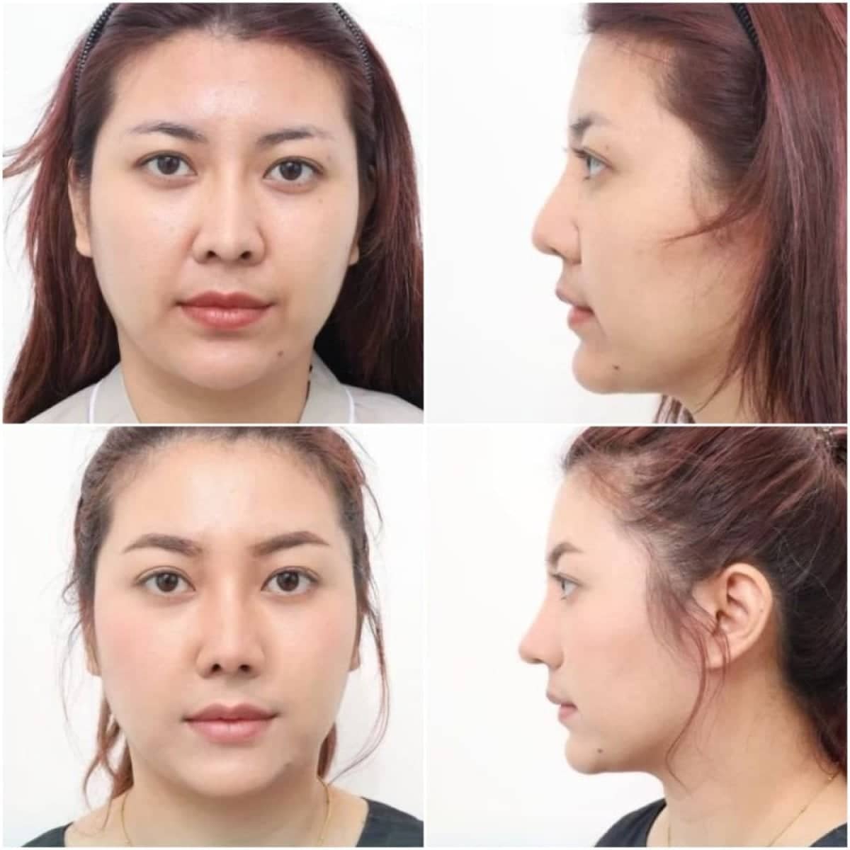 Case 20051 - rhinoplasty
