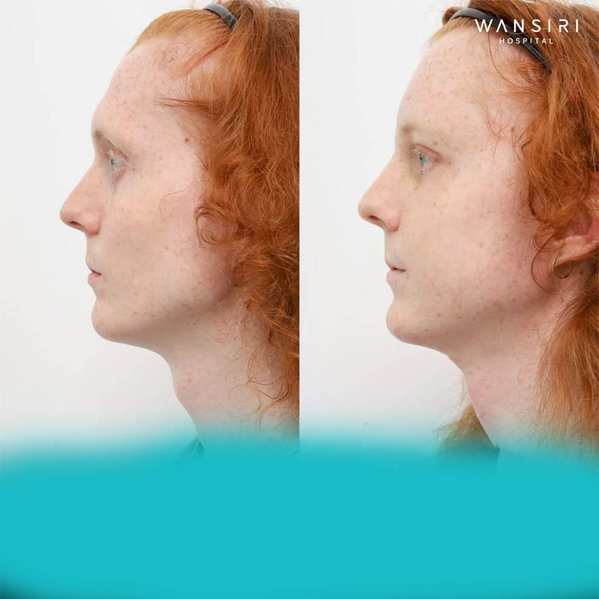 Case 20052 - Adam's apple reduction