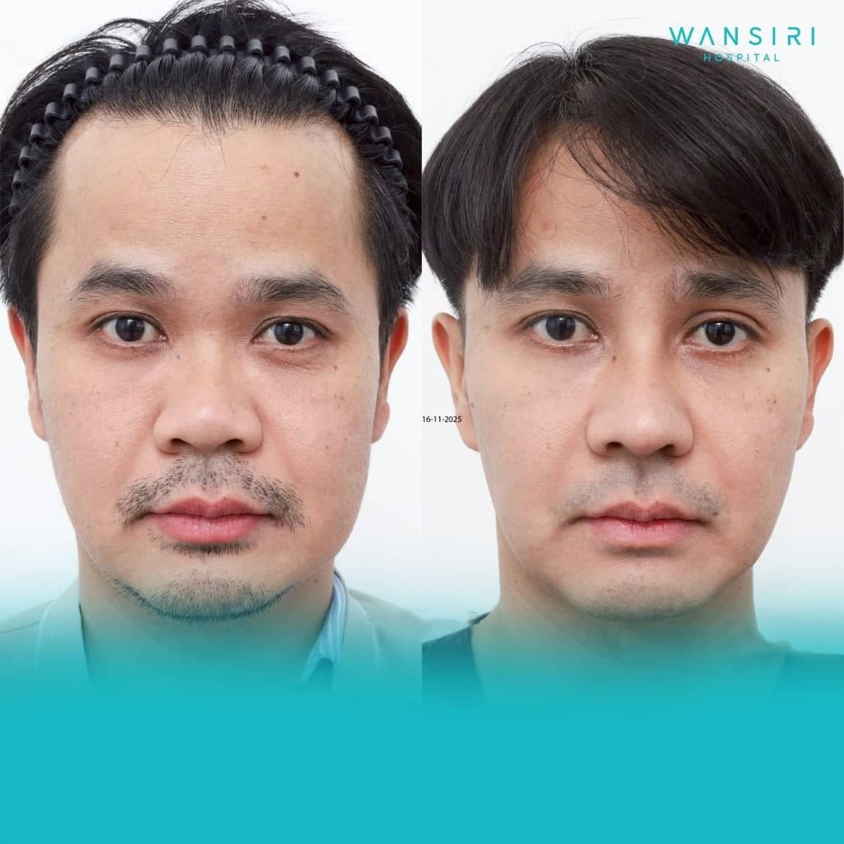 Case 20053 - buccal fat extraction
