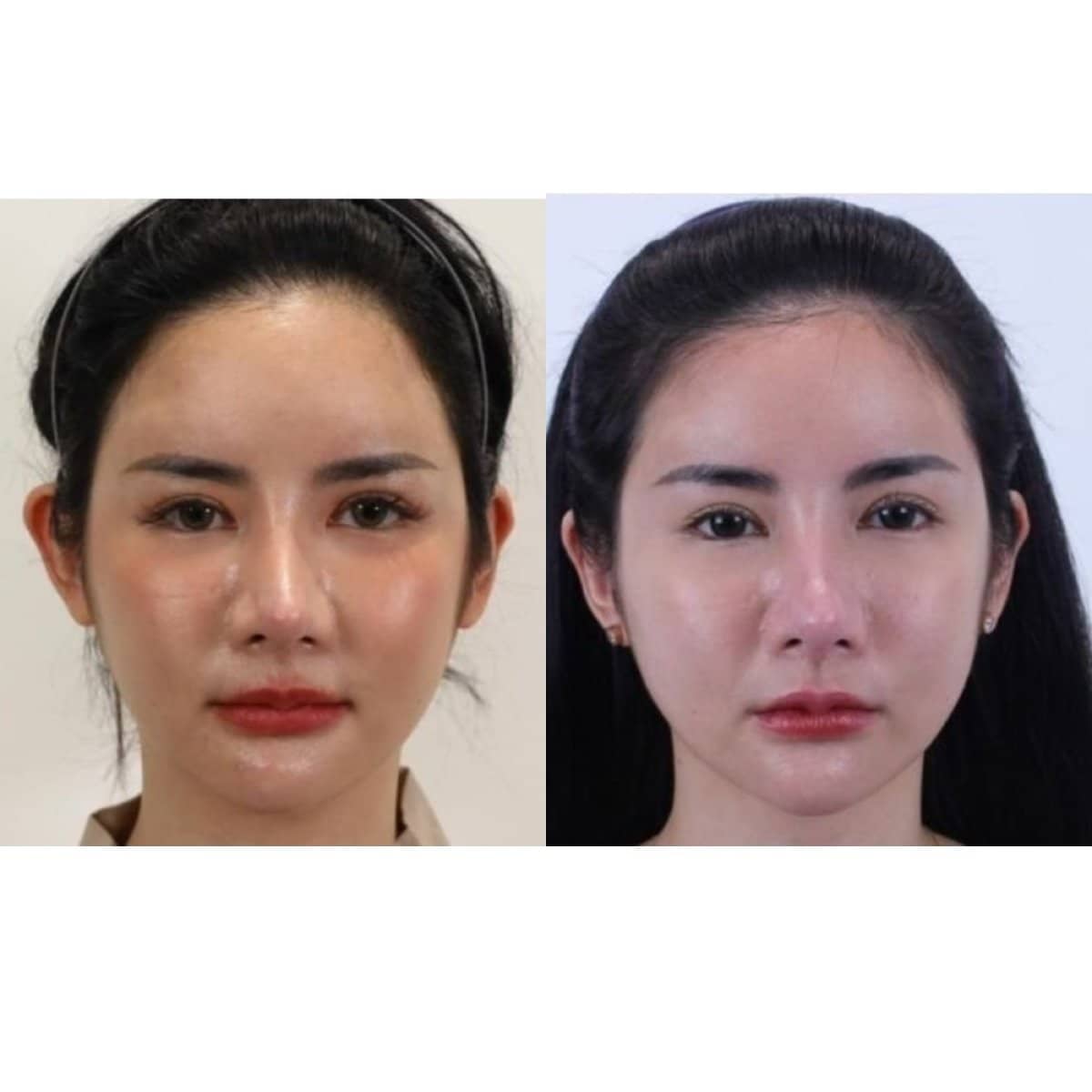 Case 20055 - otoplasty