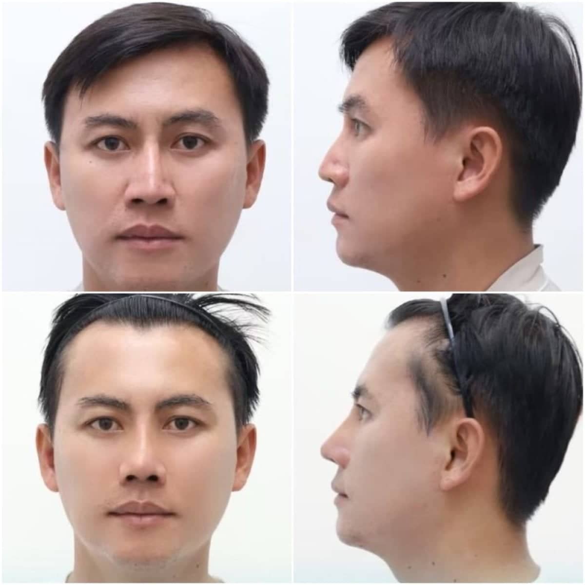 Case 20056 - rhinoplasty