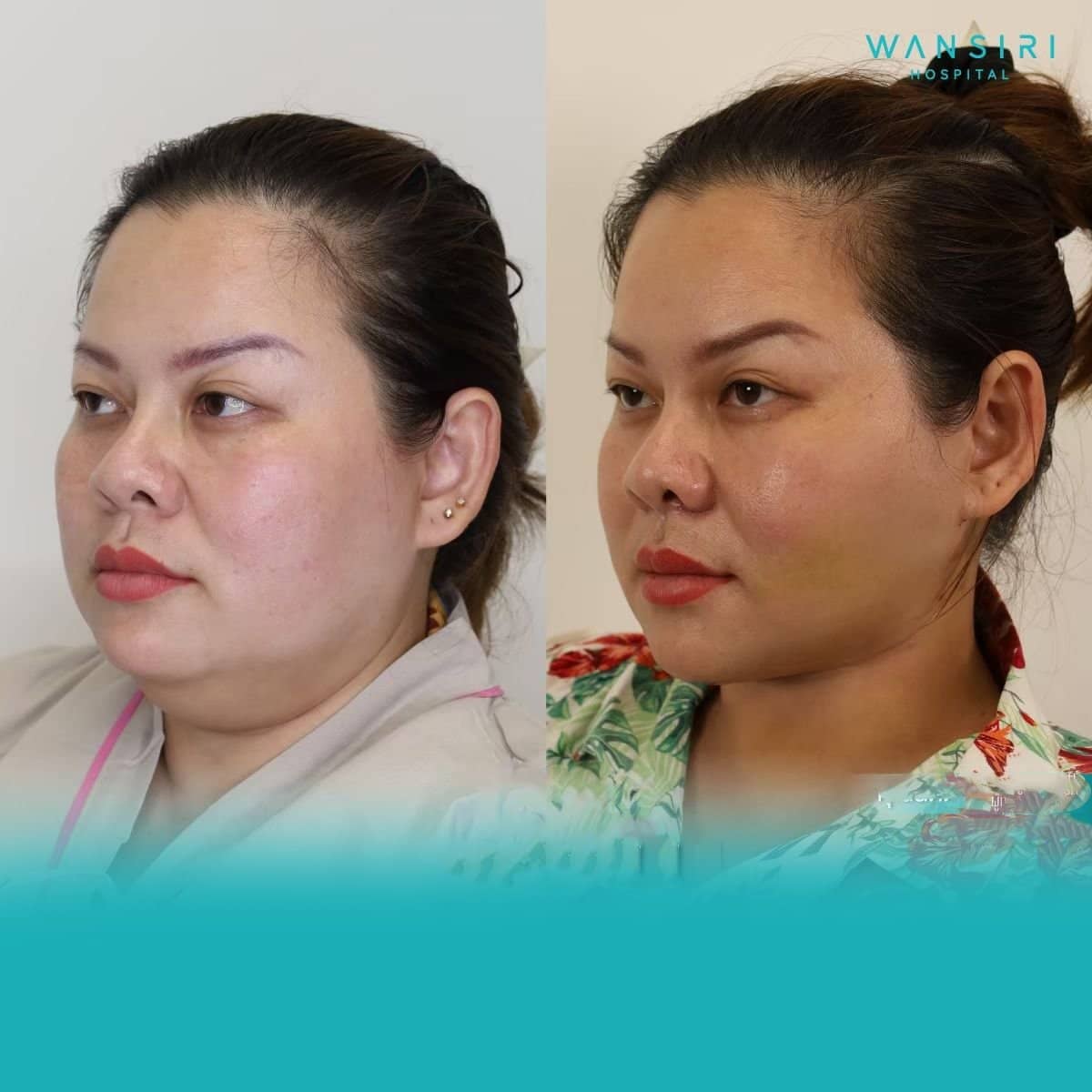Case 20058 - Vaser liposuction