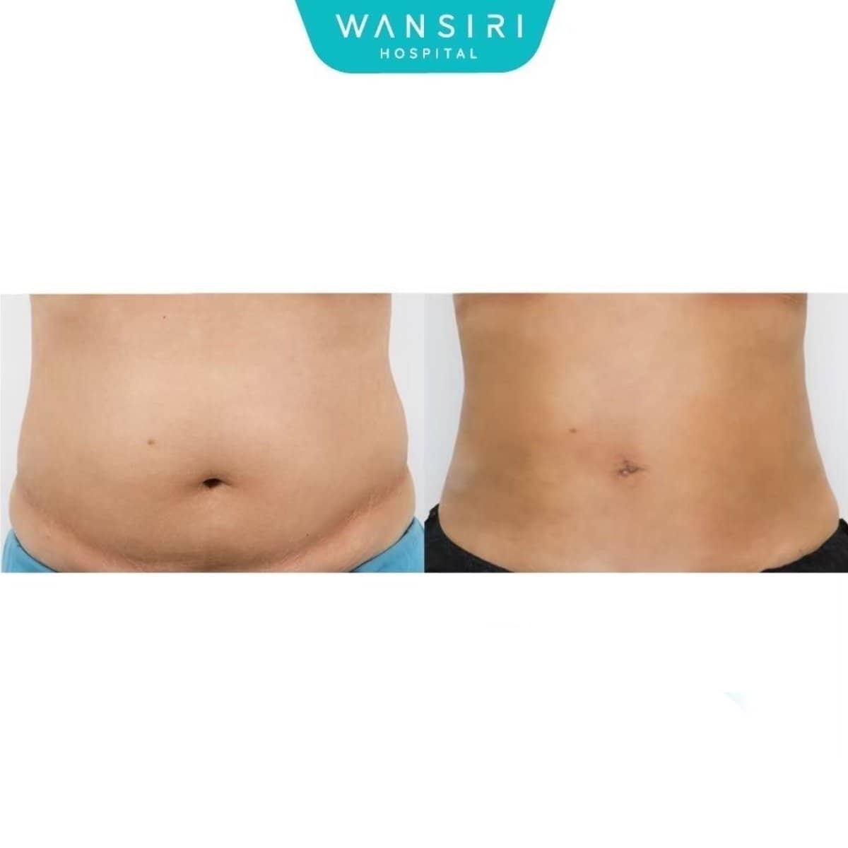 Case 20061 - love handles liposuction