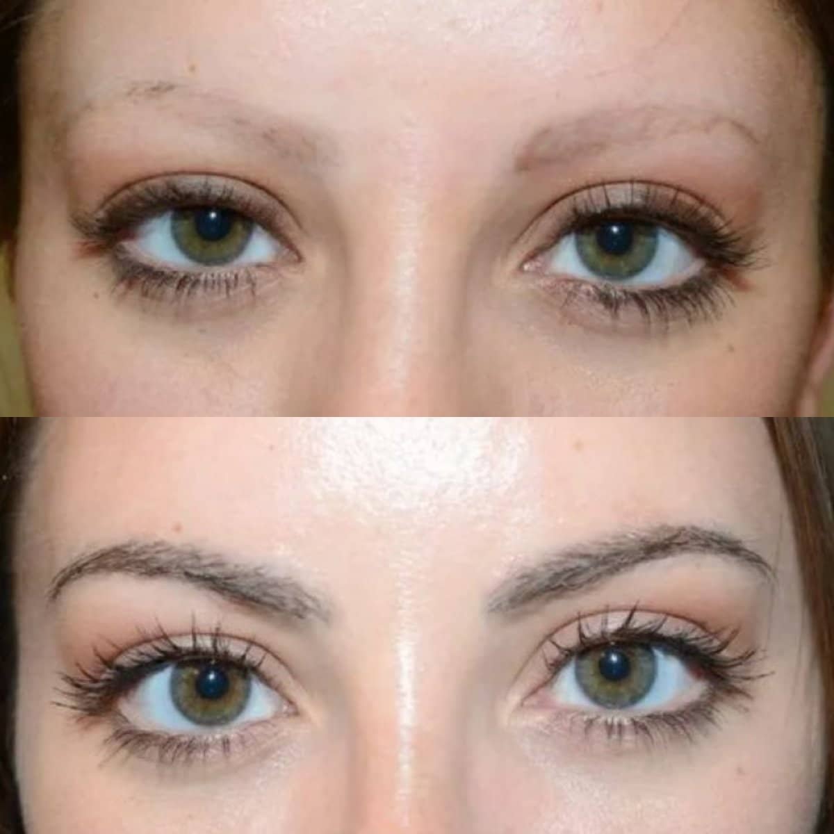 Case 20062 - eyebrow transplantation