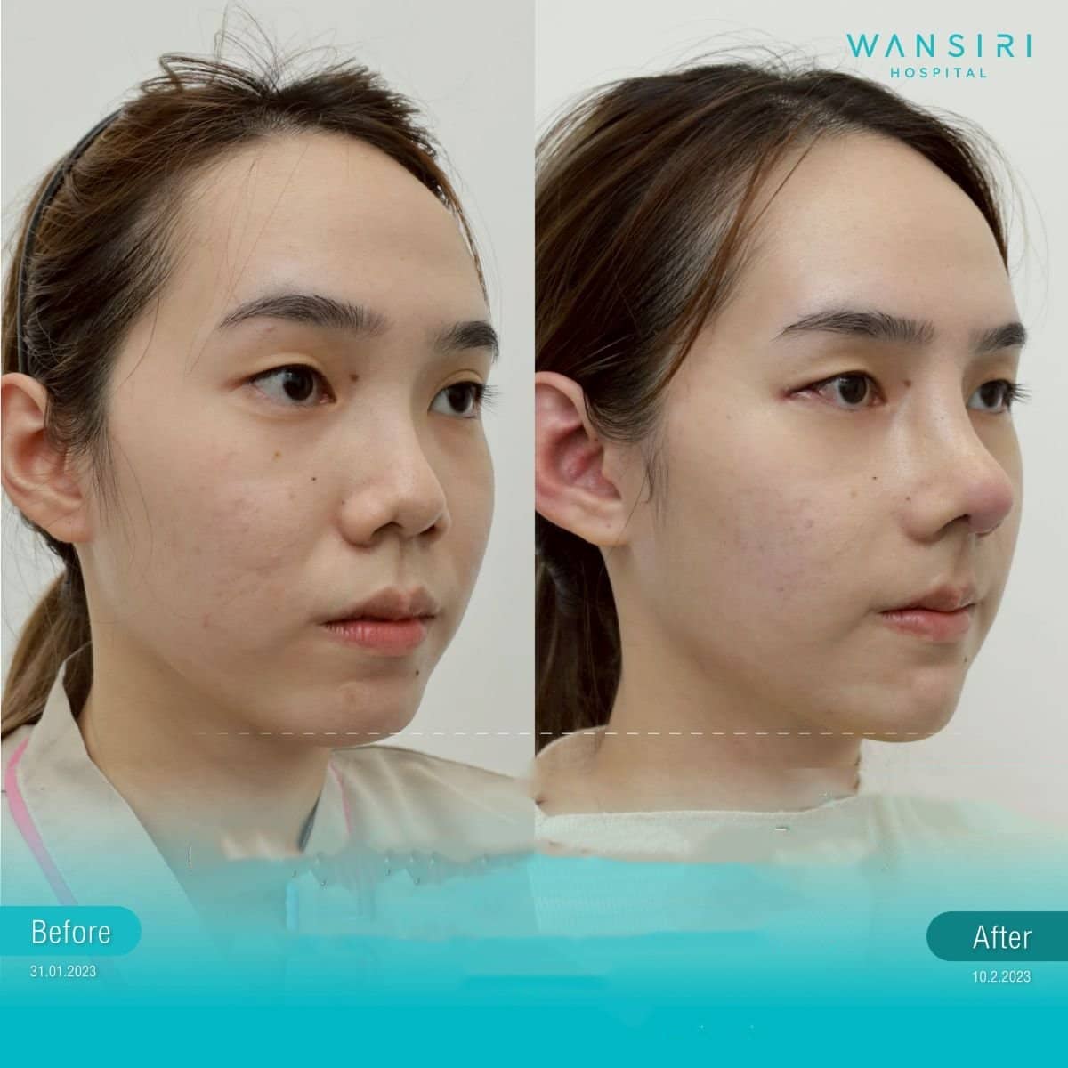Case 20064 - deep plane facelift