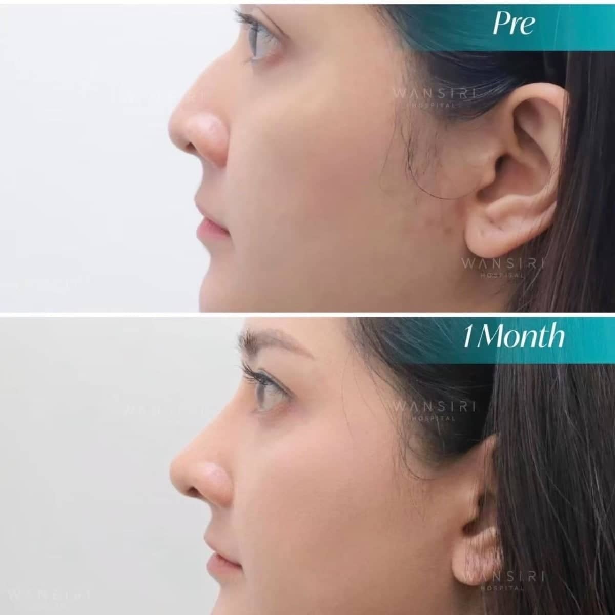 Case 20071 - septoplasty