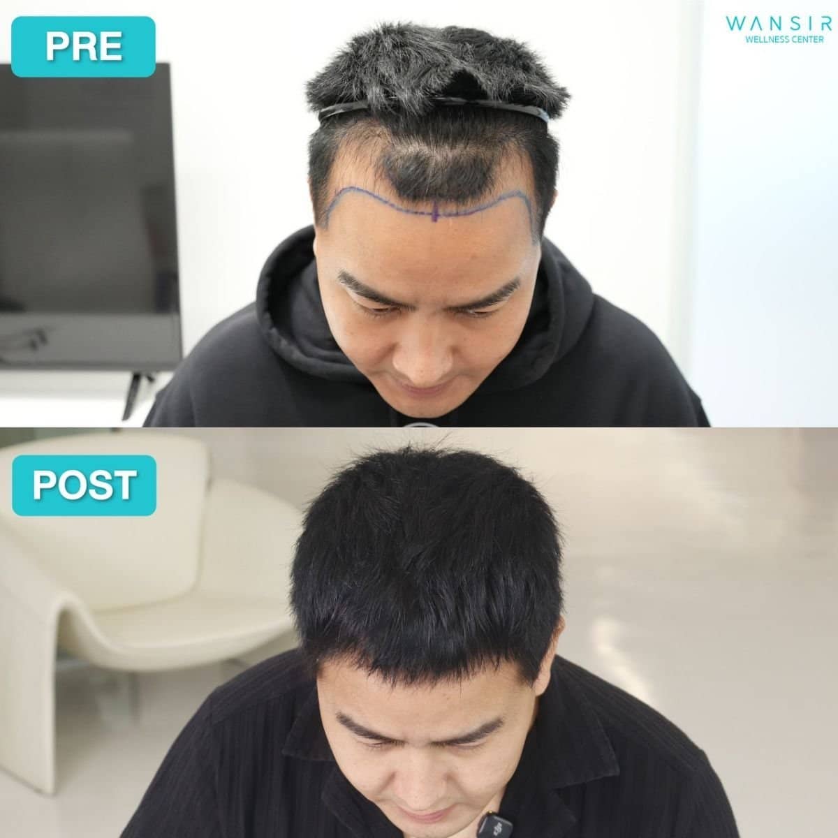 Case 20074 - FUE hair transplant