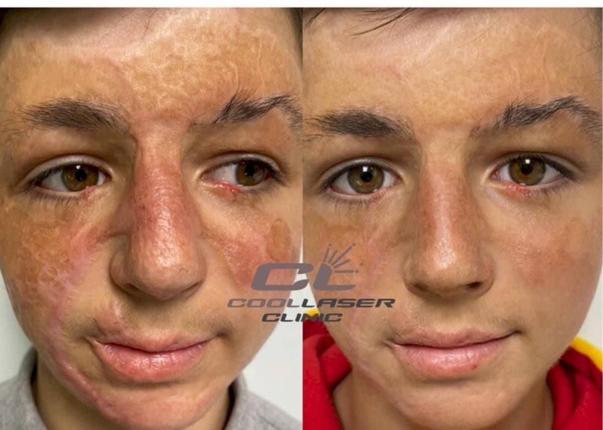 Case 20080 - laser skin resurfacing