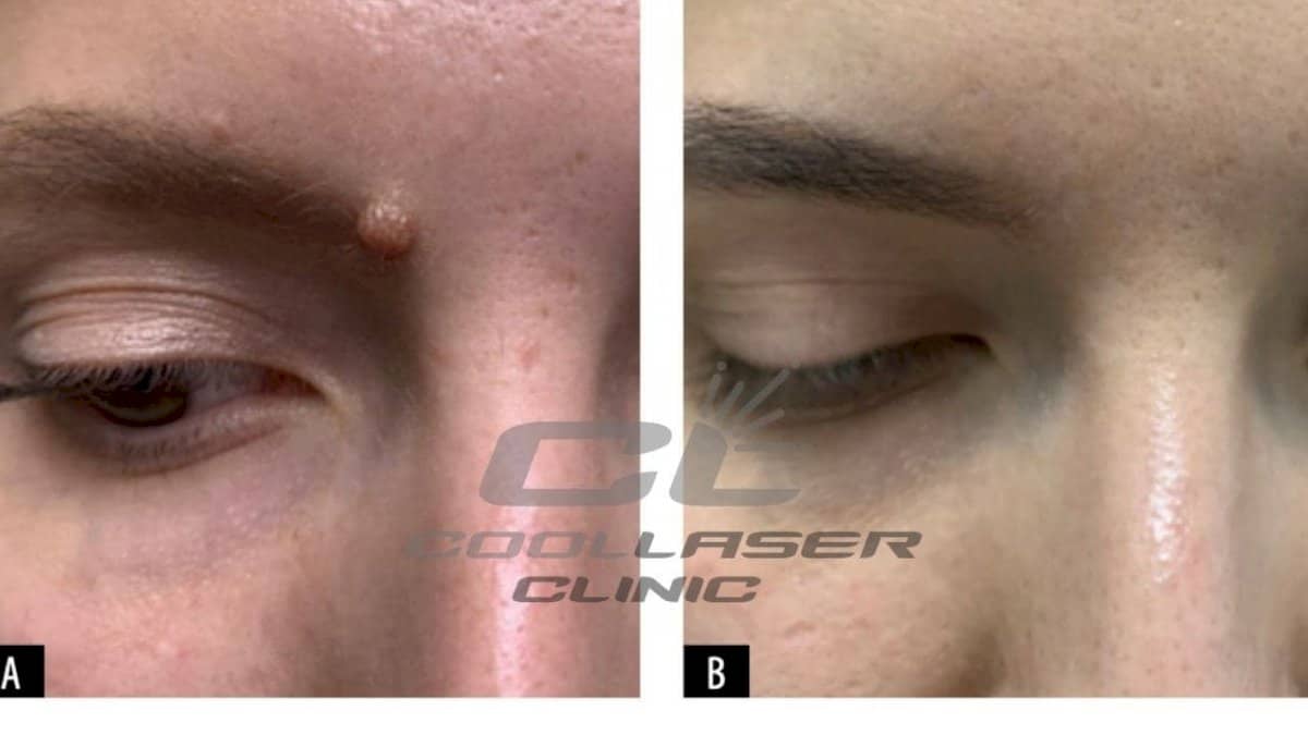Case 20081 - mole removal