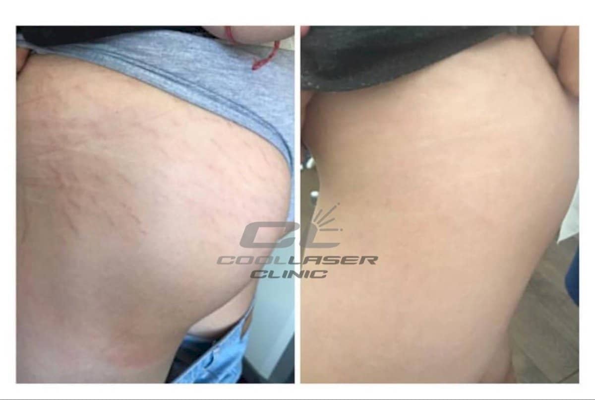 Case 20089 - laser skin resurfacing