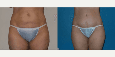 Case 201 - Woman treated with Tummy Tuck