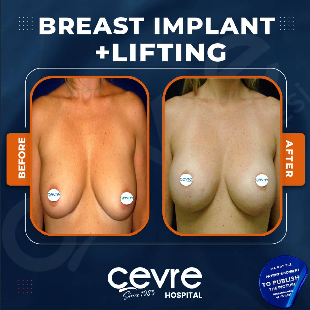 Case 20138 - breast implant and lift