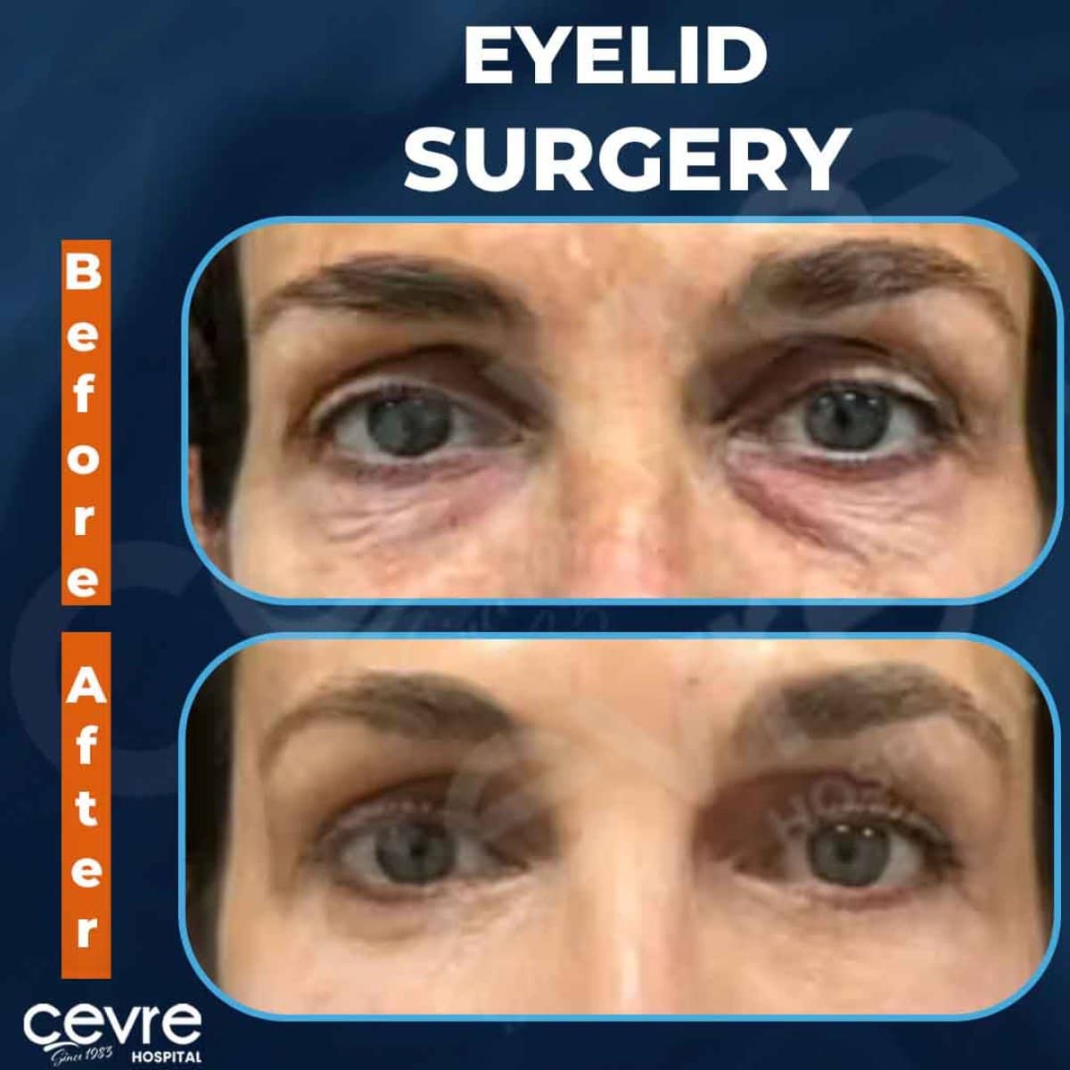 Case 20141 - blepharoplasty