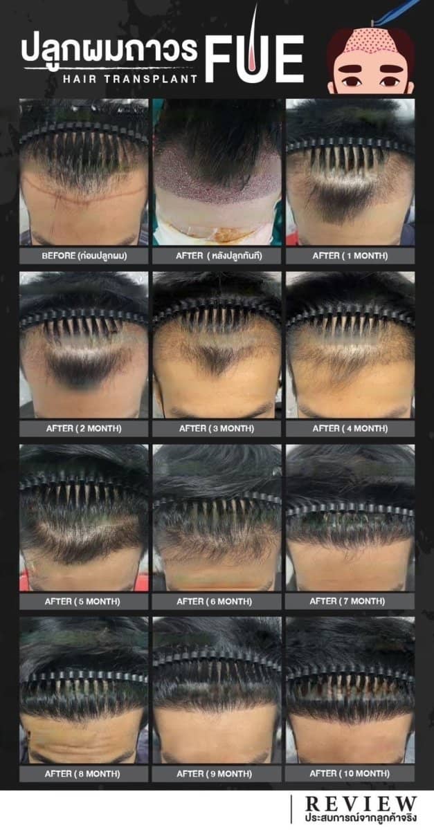 Case 20142 - FUE hair transplant