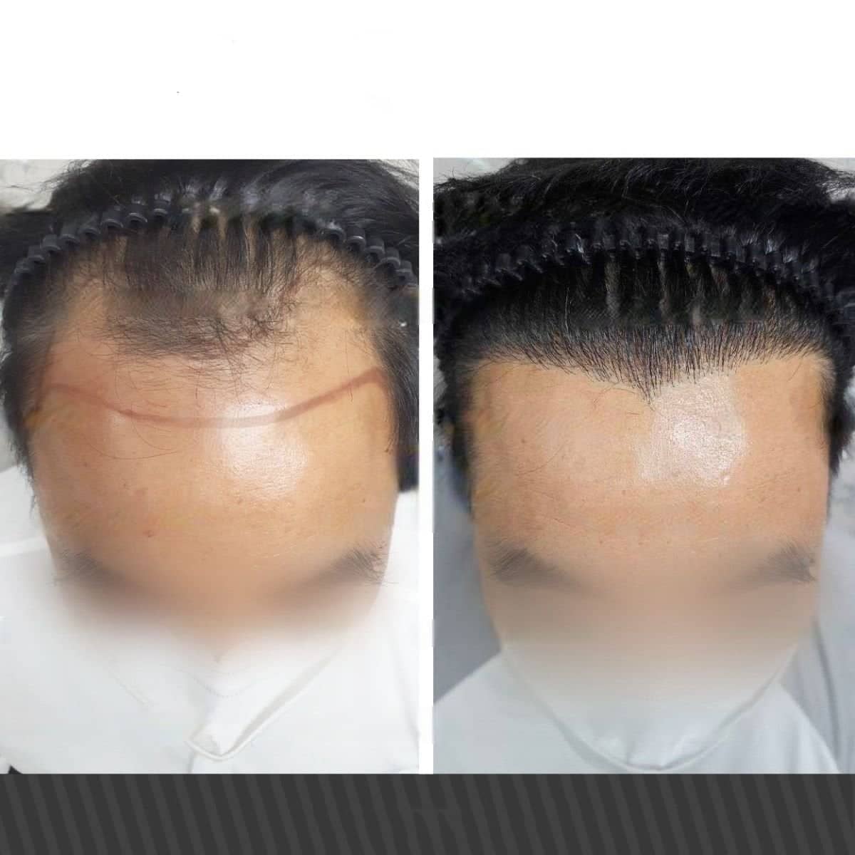 Case 20143 - hair transplant