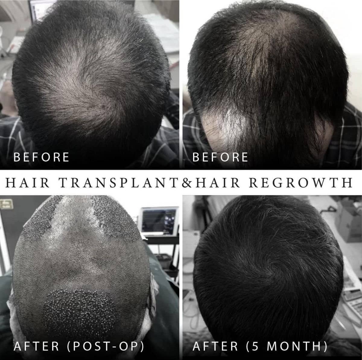 Case 20144 - hair transplant