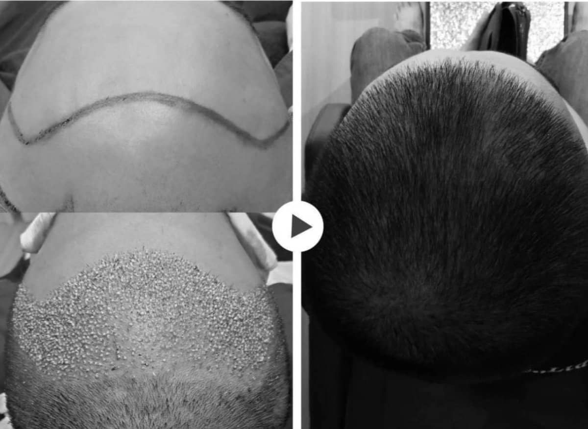 Case 20145 - FUE hair transplant