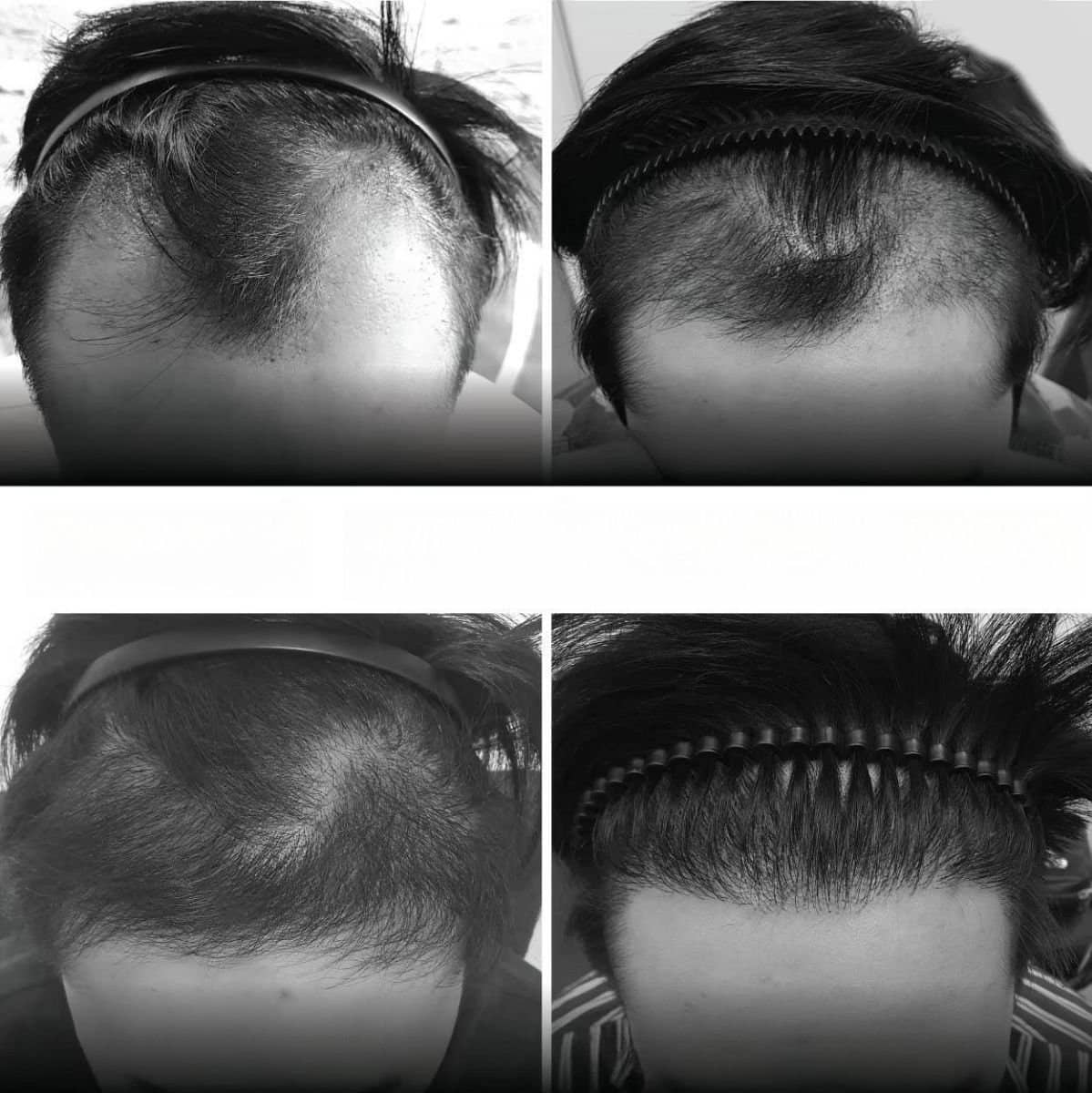 Case 20146 - hair transplant
