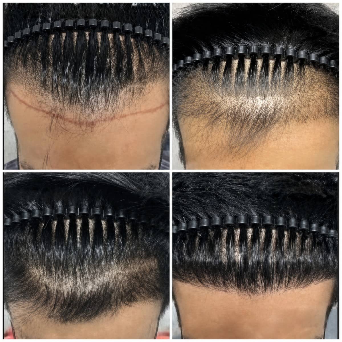 Case 20149 - FUE hair transplant