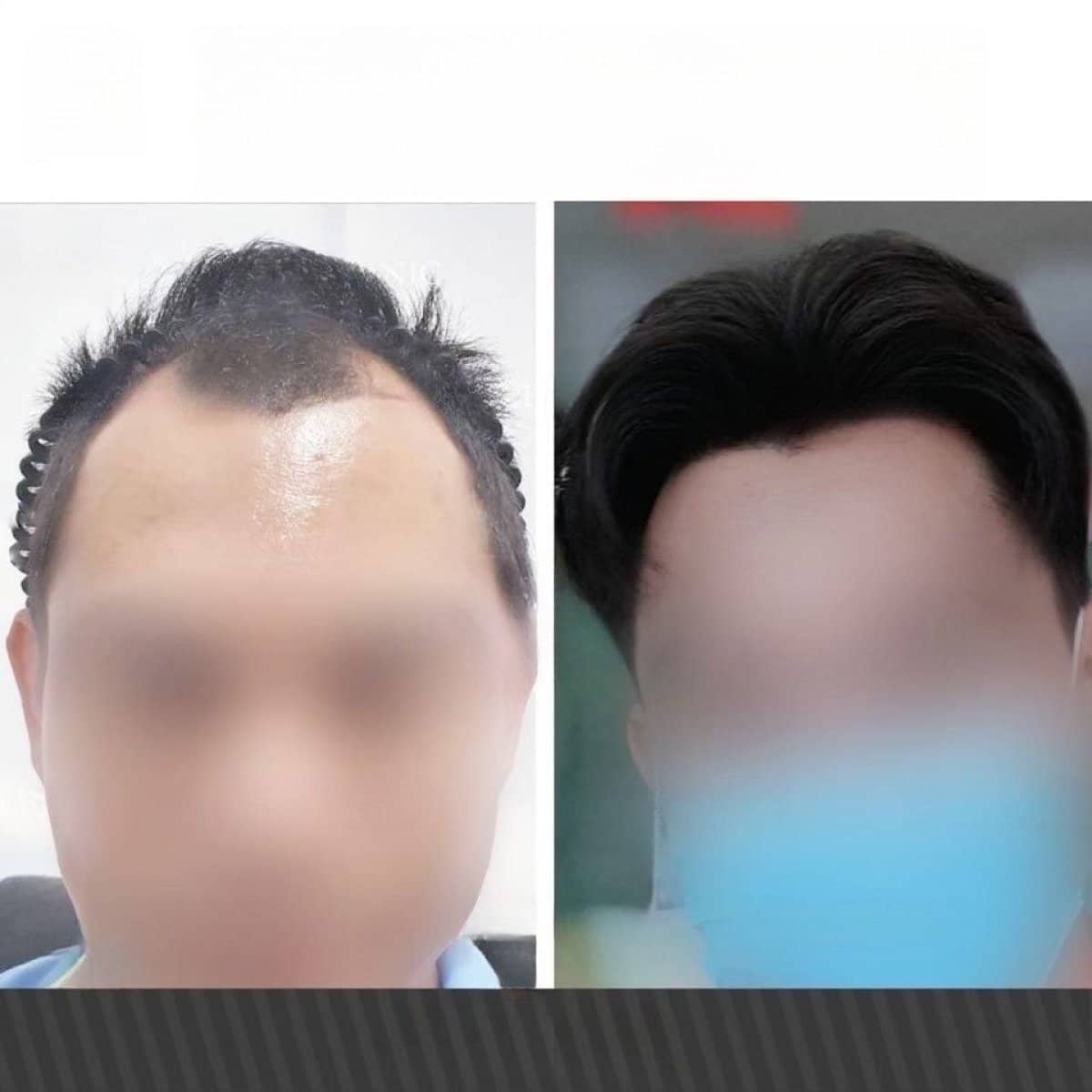 Case 20152 - hair transplant