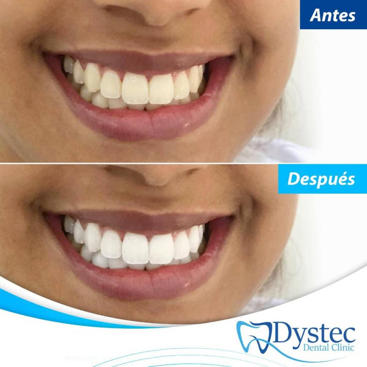 Case 20235 - tooth whitening