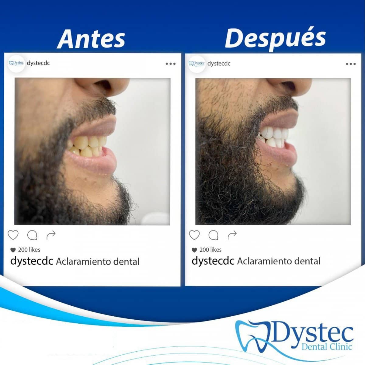 Case 20236 - tooth whitening