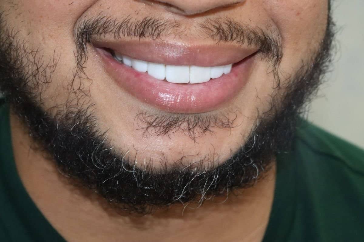 Case 20240 - before and after