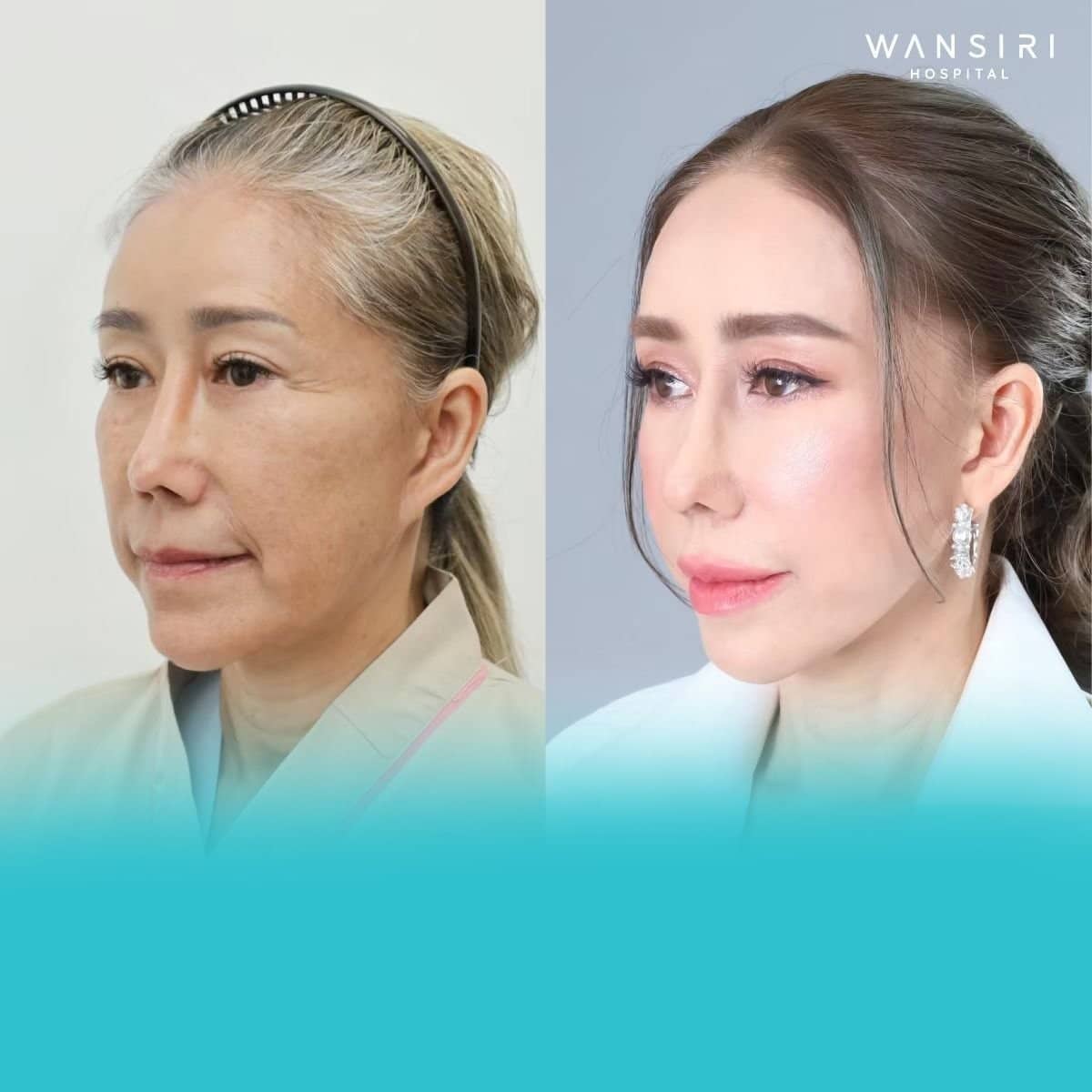 Case 20316 - Ultherapy