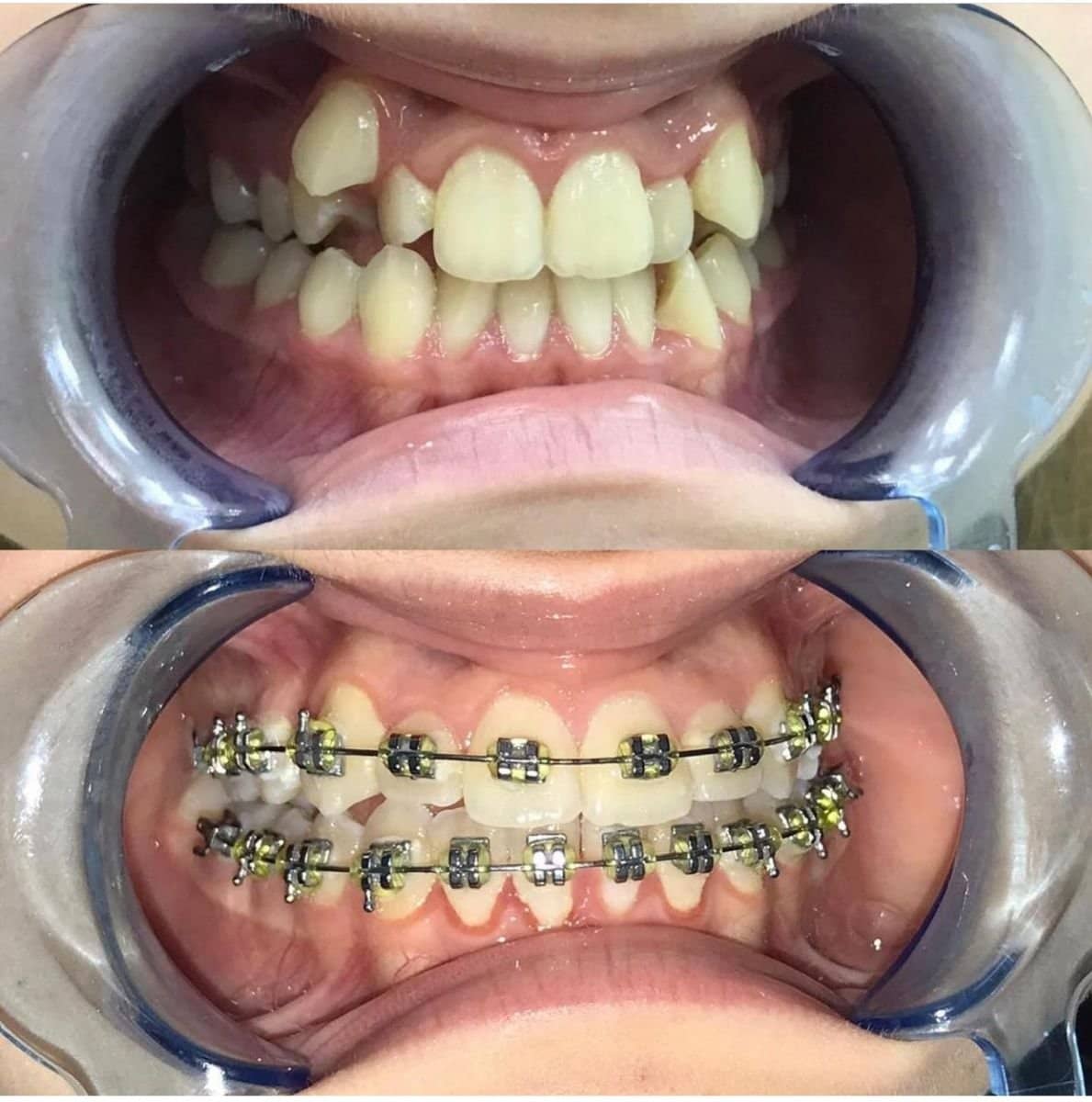 Case 20348 - ceramic braces treatment