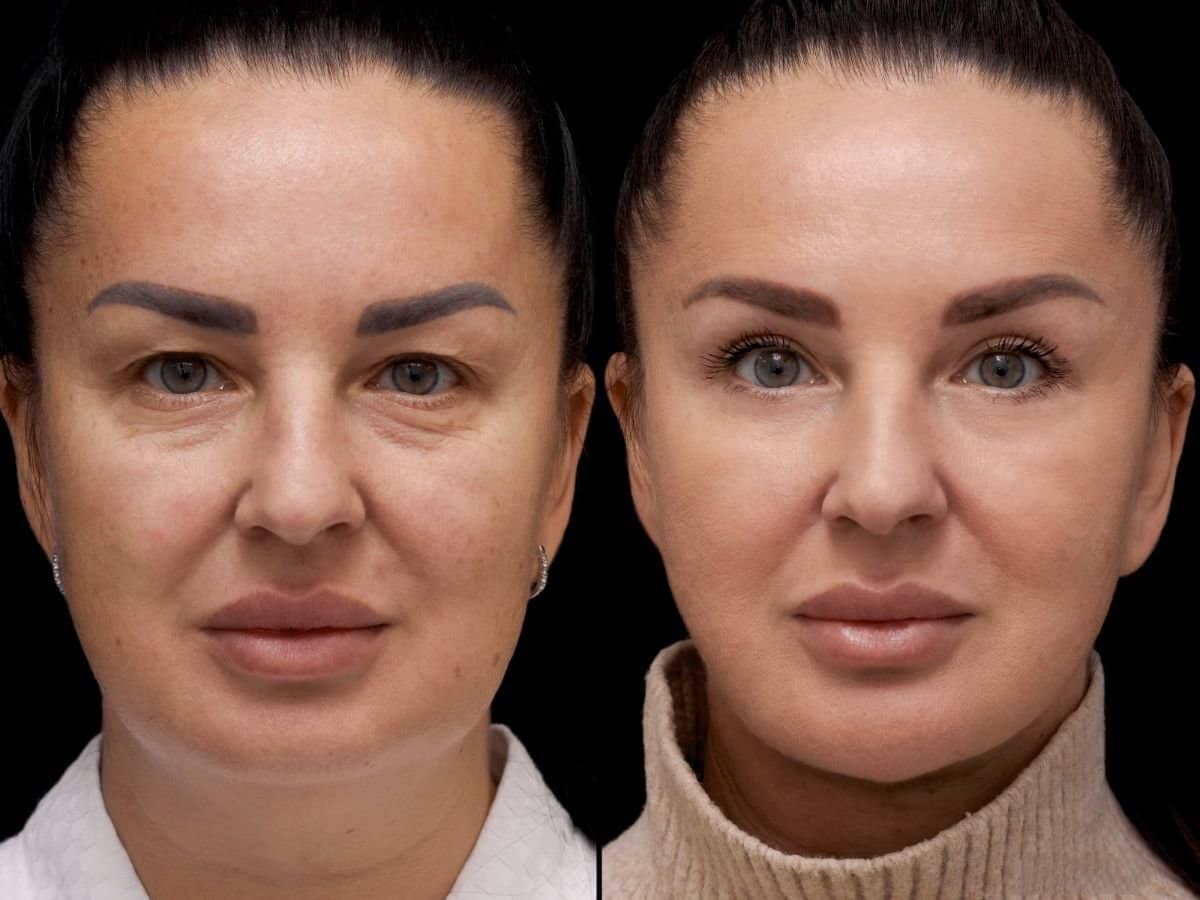 Case 20355 - facelift