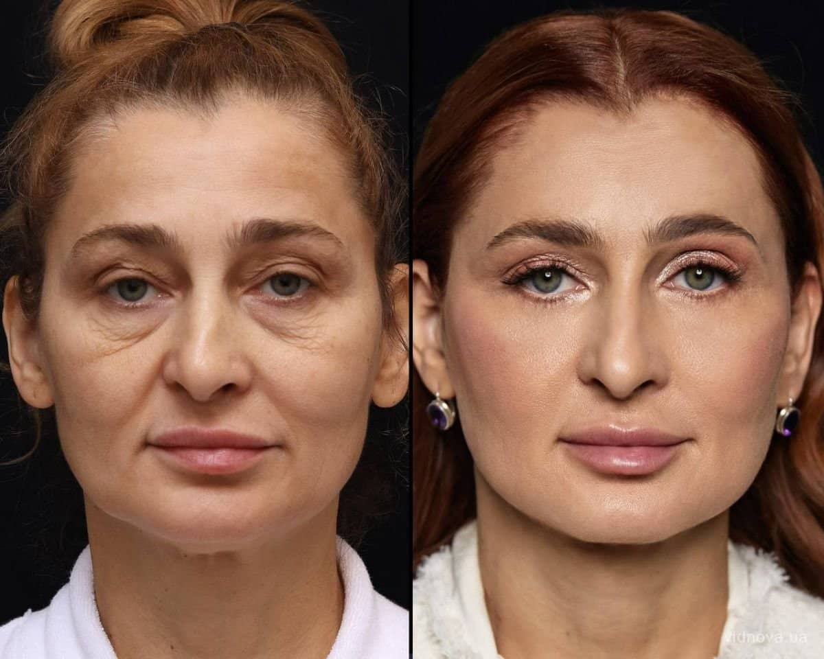 Case 20357 - lipofilling