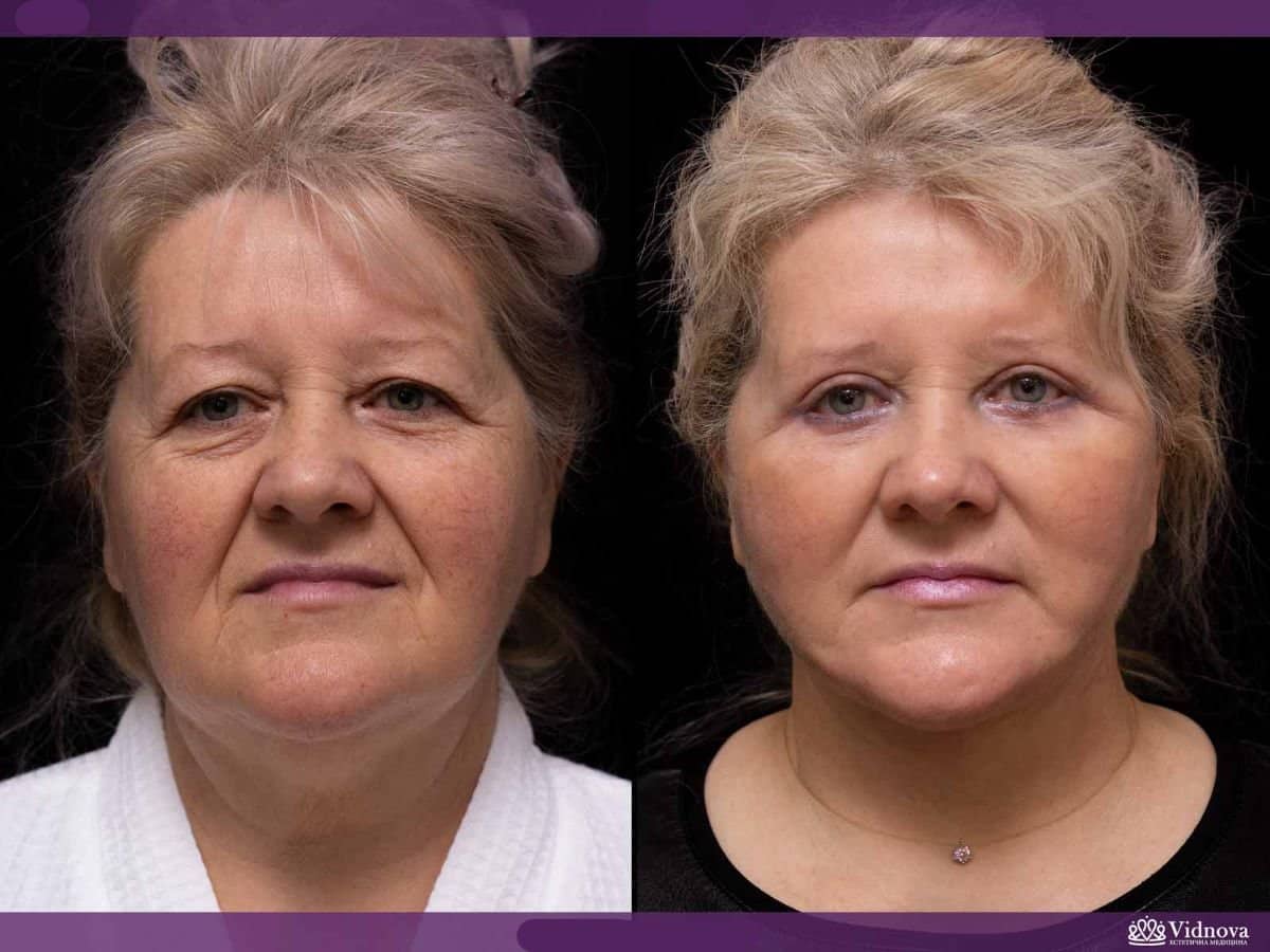 Case 20358 - facelift