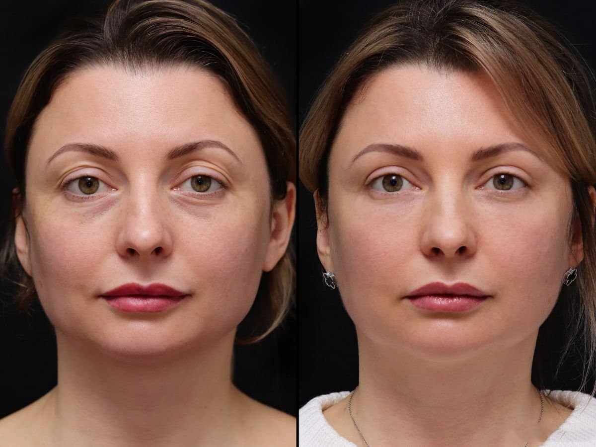 Case 20359 - facelift
