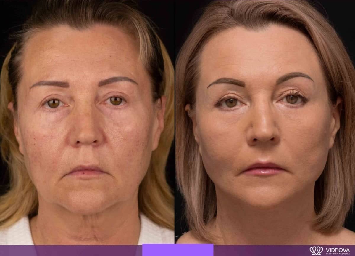 Case 20360 - brow lift