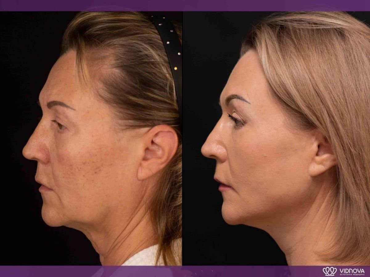 Case 20362 - lipofilling