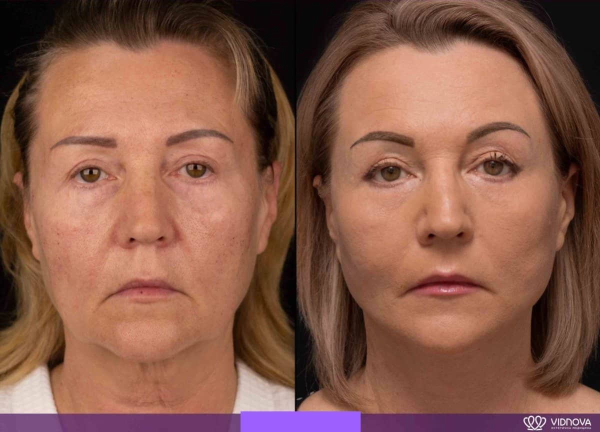 Case 20363 - facelift