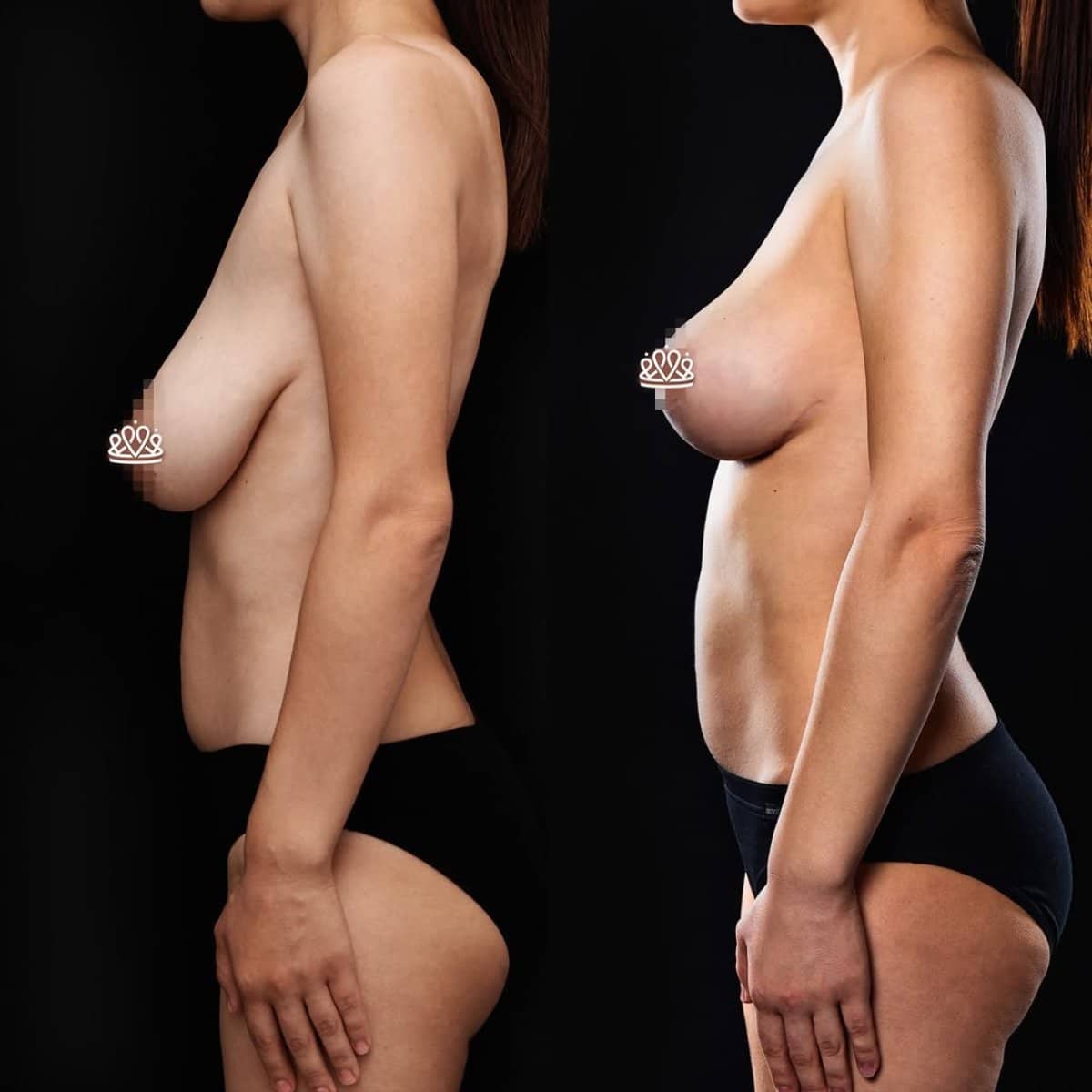 Case 20366 - breast reduction